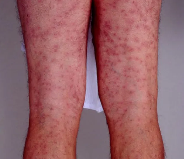 swimmers-itch